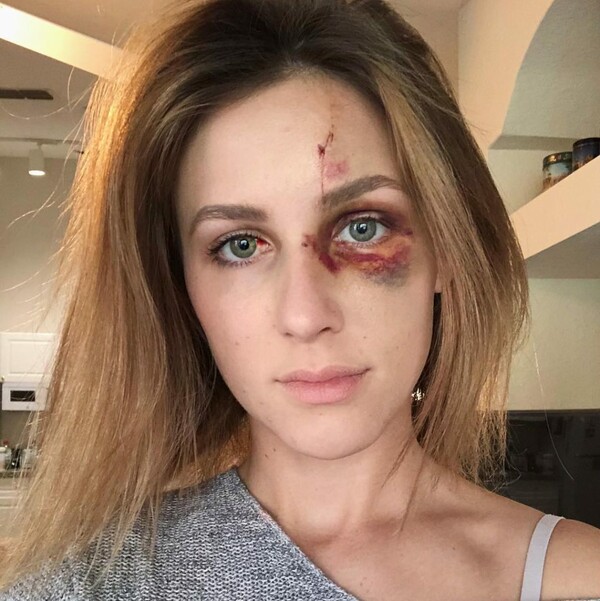 Τα περισσότερα θύματα σιωπούν, αλλά αυτή η 22χρονη δημοσίευσε τις φωτογραφίες στο Instagram