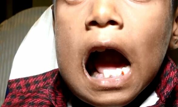 Γιατροί αφαίρεσαν 526 δόντια από το στόμα ενός 7χρονου αγοριού στην Ινδία