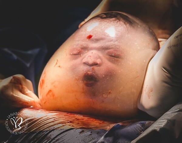 Η πολύ σπάνια γέννα μωρού μέσα στον αμνιακό σάκο