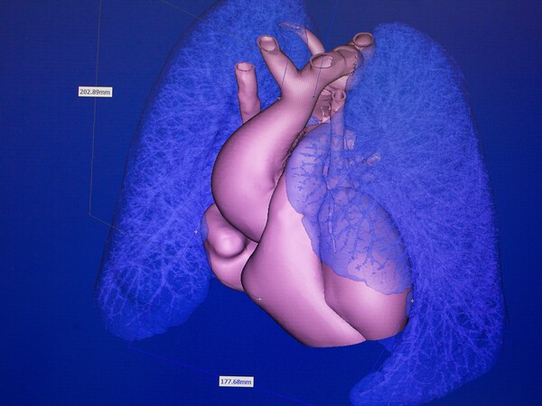 O πρωτοπόρος Έλληνας καρδιοχειρουργός που εκτυπώνει καρδιές σε 3D printer