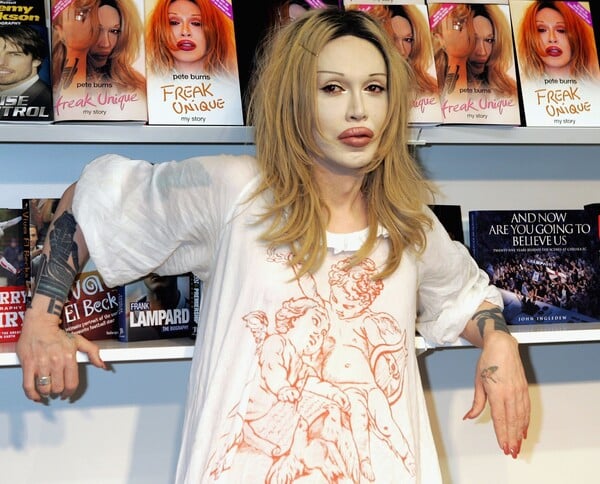 Πέθανε ο Pete Burns, τραγουδιστής και σταρ του Celebrity Big Brother
