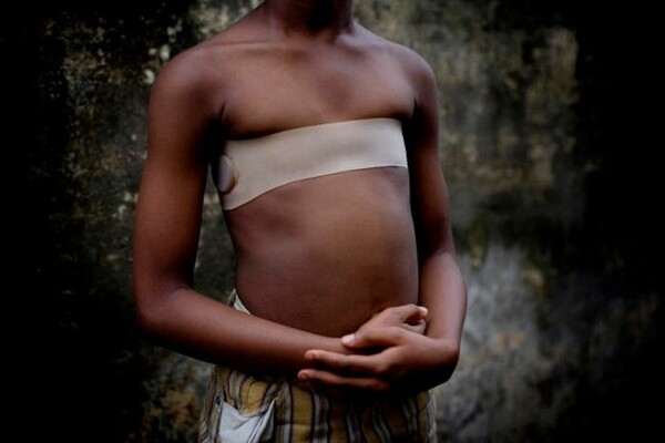 Βρετανία: Δεκάδες μικρά κορίτσια υποβάλλονται σε «σιδέρωμα στήθους» για να μην τις ποθούν οι άντρες