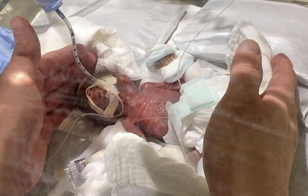 Το μικρότερο νεογέννητο αγόρι στον κόσμο γεννήθηκε μόλις 268 γραμμάρια