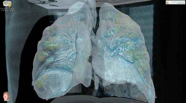 Κορωνοϊός: 3D βίντεο δείχνει τη ζημιά στους πνεύμονες ασθενούς - «Πρέπει να το πάρουμε πολύ σοβαρά»