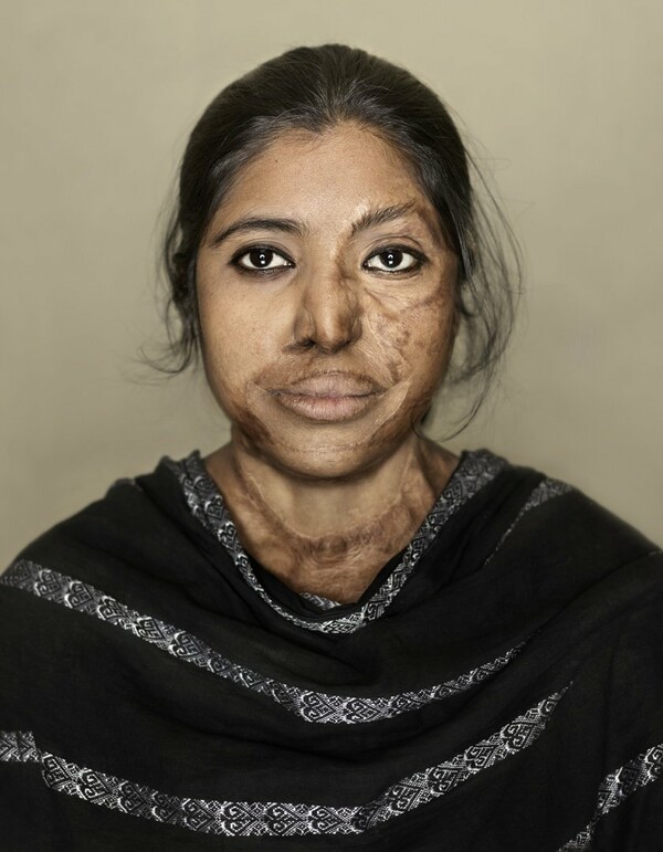 Η Umma δέχτηκε επίθεση με οξύ από τον σύζυγό της όταν ήταν μόλις 15