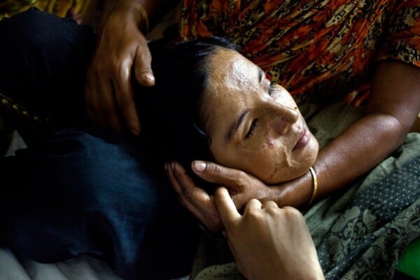 Lingering Scars: Το σκληρό πρόσωπο των επιθέσεων με βιτριόλι