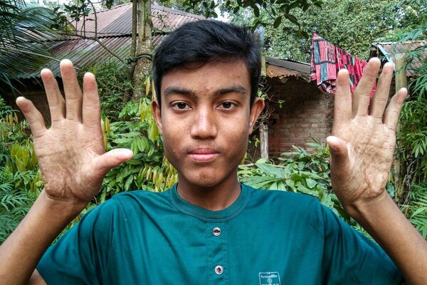 Μπαγκλαντές: Η περίεργη υπόθεση της οικογένειας χωρίς δακτυλικά αποτυπώματα [ΕΙΚΟΝΕΣ]