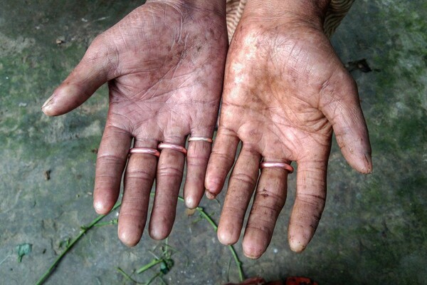 Μπαγκλαντές: Η περίεργη υπόθεση της οικογένειας χωρίς δακτυλικά αποτυπώματα [ΕΙΚΟΝΕΣ]