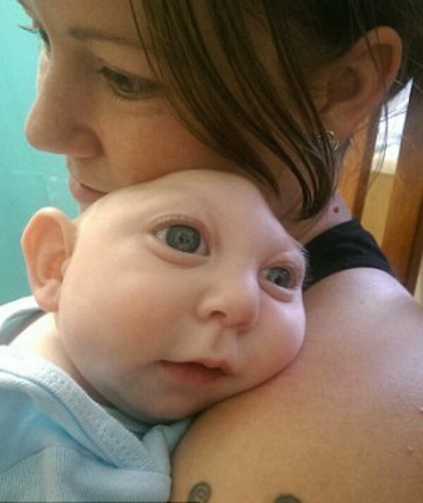 Mωρό που γεννήθηκε με μισό κεφάλι αψηφά τις προβλέψεις των γιατρών
