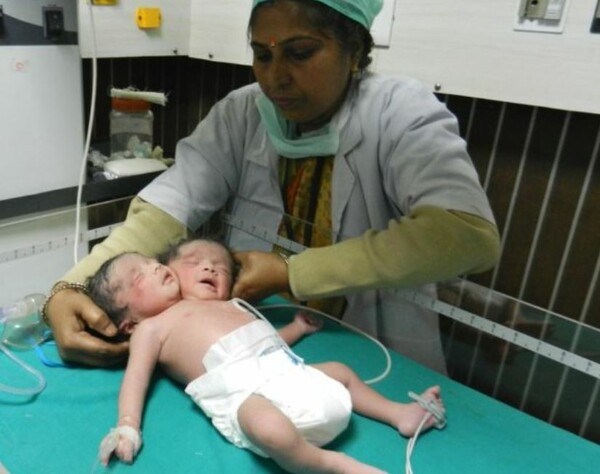 Mωρό με δύο κεφάλια στην Ινδία