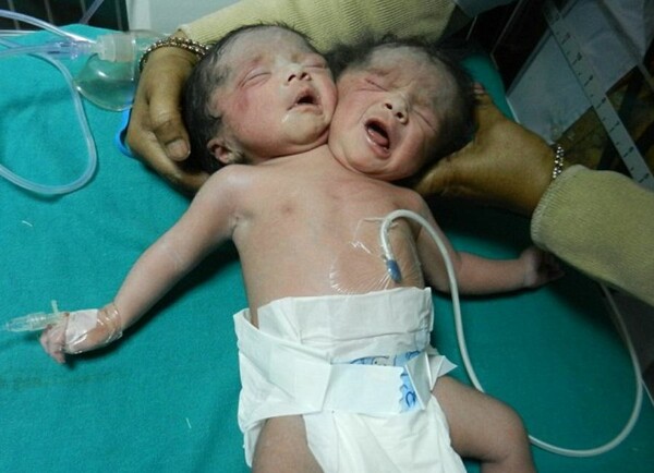 Mωρό με δύο κεφάλια στην Ινδία