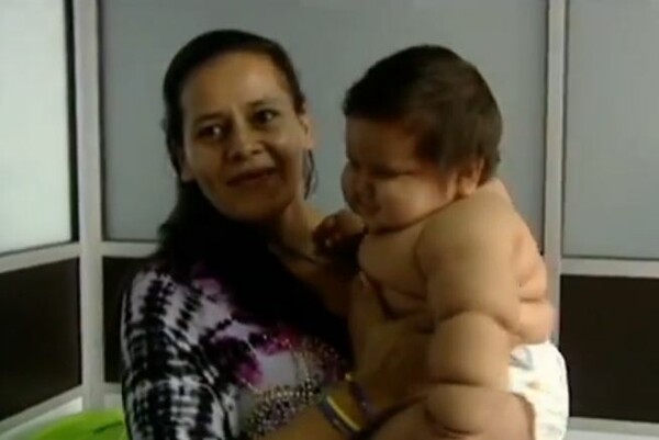 Οκτώ μηνών μωρό στην Κολομβία ζυγίζει 21 κιλά