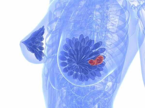 Τεστ αίματος προβλέπει αν μια γυναίκα θα επανεμφανίσει καρκίνο του μαστού