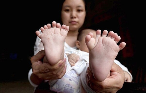Μωρό στην Κίνα γεννήθηκε με 15 δάχτυλα στα χέρια και 16 στα πόδια