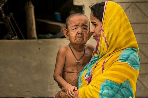 Η ιστορία του 4χρονου από το Μπαγκλαντές που λόγω της σπάνιας ασθένειάς του δεν μοιάζει με τα παιδιά της ηλικίας του