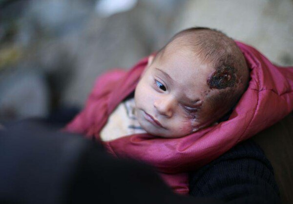 Συγκλονίζει το μωρό στη Συρία που έχασε το μάτι του σε βομβαρδισμό