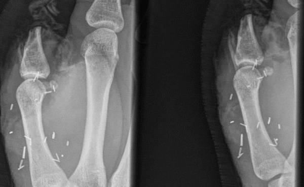 Ένας 20χρονος έχασε τον αντίχειρά του και οι γιατροί τον αντικατέστησαν με δάχτυλο του ποδιού