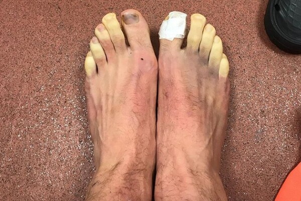 Πώς δείχνουν τα πόδια ενός ποδοσφαιριστή μετά από αγώνα σε χαμηλές θερμοκρασίες...