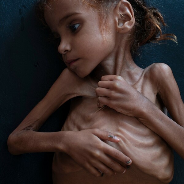 Πέθανε το κορίτσι σύμβολο του λιμού - H Αμάλ της συγκλονιστικής φωτογραφίας των New York Times