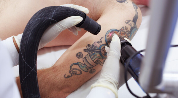 Πώς να αφαιρέσεις τα tattoos που δεν σου αρέσoυν πια