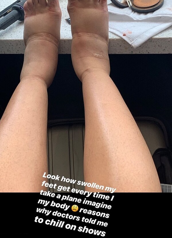 Η Cardi B δημοσίευσε φωτογραφία με τα πρησμένα πόδια της και εξηγεί τι της συμβαίνει