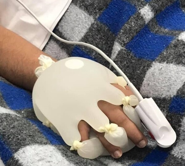 «Χέρια αγάπης»: Πλαστικά γάντια με ζεστό νερό «βοηθούν» ασθενείς με κορωνοϊό