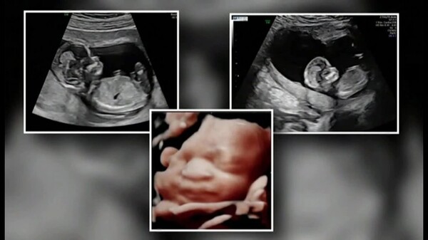 Τρίδυμες έμειναν έγκυες ταυτόχρονα- Γεννήθηκαν με 4 λεπτά διαφορά και γεννούν στους επόμενους 4 μήνες
