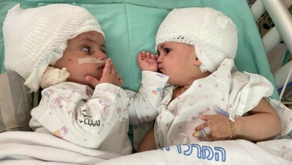 Δίδυμες αδελφές, που γεννήθηκαν ενωμένες στο κεφάλι, είδαν για πρώτη φορά η μία την άλλη