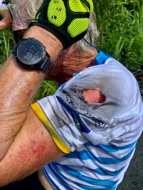 Recovering from a colossal cycling crash (again!)