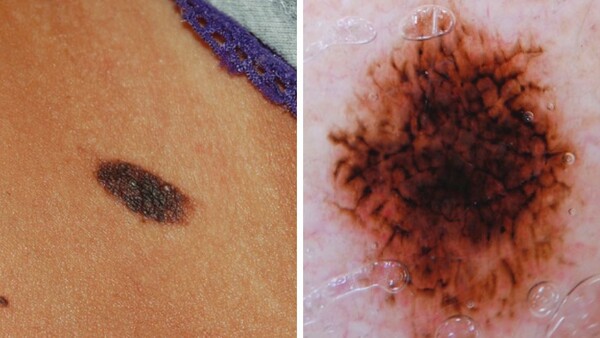 Influencers διαφημίζουν «επικίνδυνα» προϊόντα για μαύρισμα- Προκαλούν μέχρι καρκίνο του δέρματος