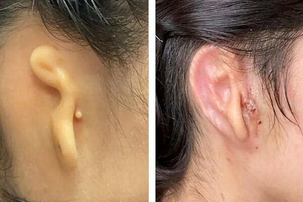 ΗΠΑ: Για πρώτη φορά γιατροί μεταμοσχεύουν αυτί κατασκευασμένο από 3D εκτυπωτή - Σε μία 20χρονη