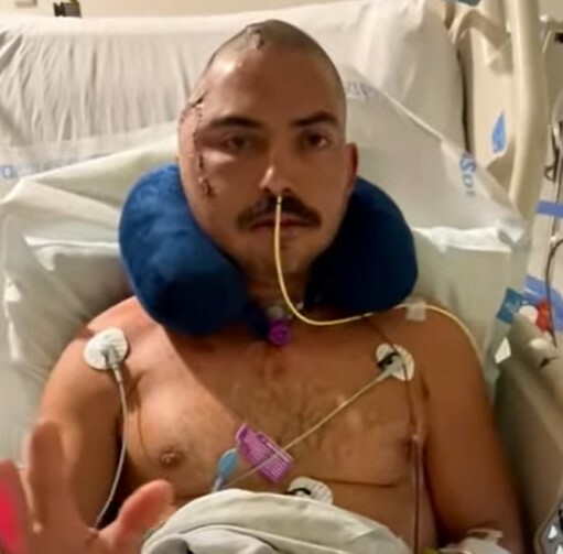 Φλόριντα: Άνδρας επέζησε μετά από επίθεση αλιγάτορα - Έχει δαγκωματιές στο κεφάλι