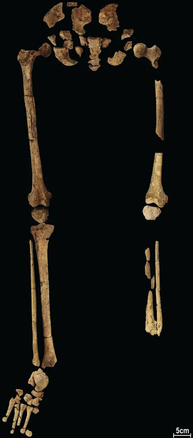 Σκελετός 31.000 ετών χωρίς πόδι αποδεικνύει την παλαιότερη χειρουργική επέμβαση