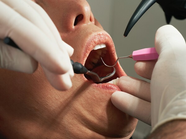 Γαλλία: Οδοντίατροι έκαναν χιλιάδες απονευρώσεις σε υγιή δόντια - Έπαιρναν αποζημιώσεις από ασφάλειες