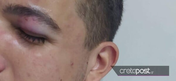 Ηράκλειο: Οδηγός ξυλοκόπησε μαθητή - Του έκανε παρατήρηση γιατί δε σταμάτησε σε διάβαση