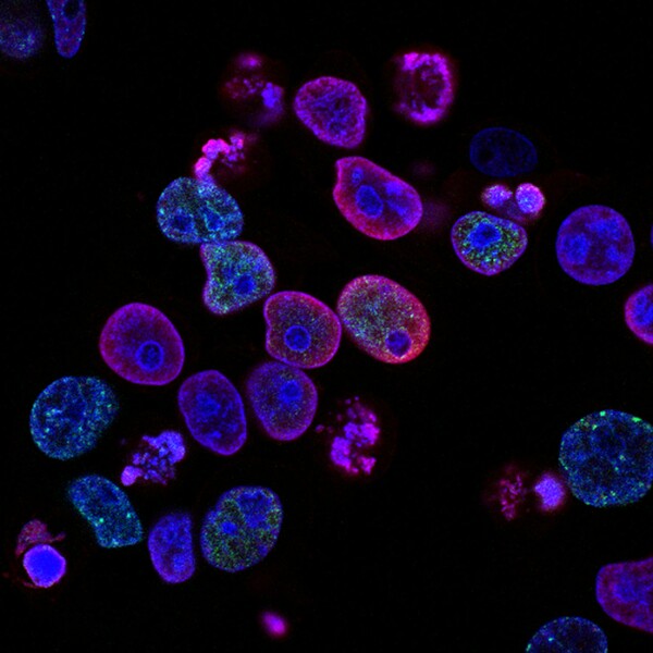 Μια νέα μέθοδος εξόντωσης καρκινικών κυττάρων, ίσως ανοίξει τον δρόμο για νέες θεραπείες
