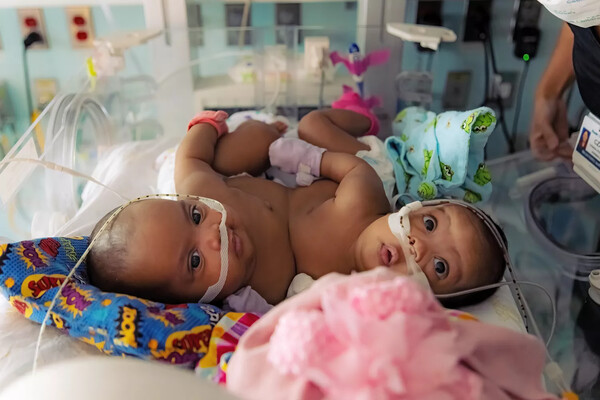 Conjoined Twin Sisters Undergo Successful Surgery to Separate at 4 Months Old