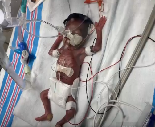 Μωρό γεννήθηκε στις 23 εβδομάδες με βάρος μόλις 450 γραμμάρια και επέζησε