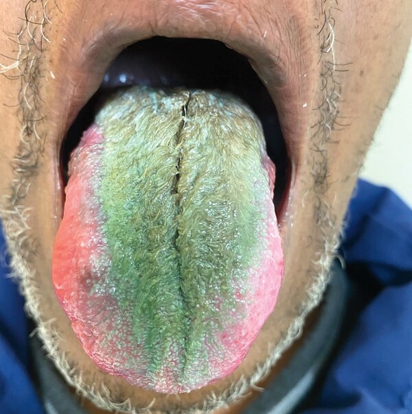 Άνδρας έβγαλε πράσινο «τρίχωμα» στη γλώσσα του