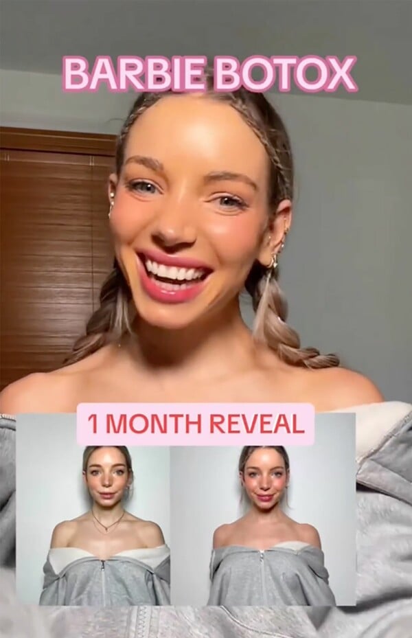 Barbie Botox: Η νέα «μανία» που σαρώνει στο TikTok