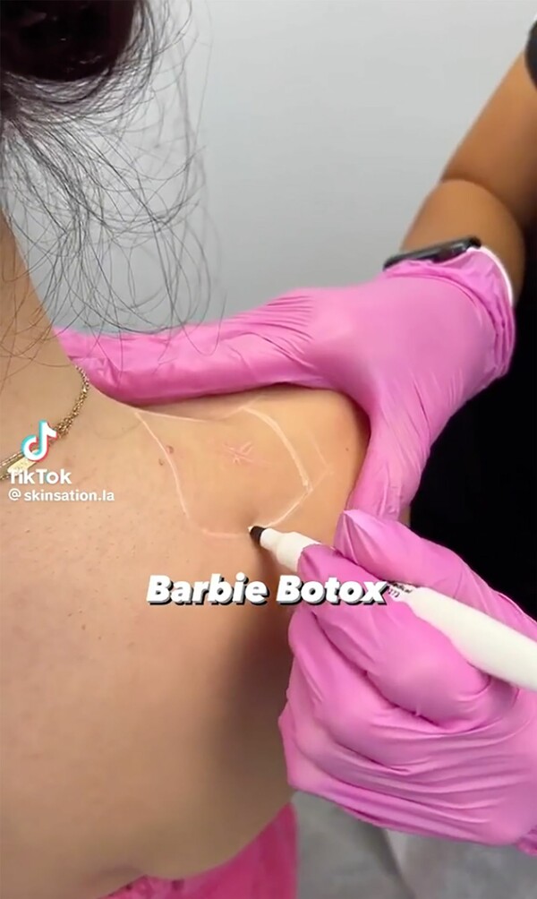 Barbie Botox: Η νέα «μανία» που σαρώνει στο TikTok