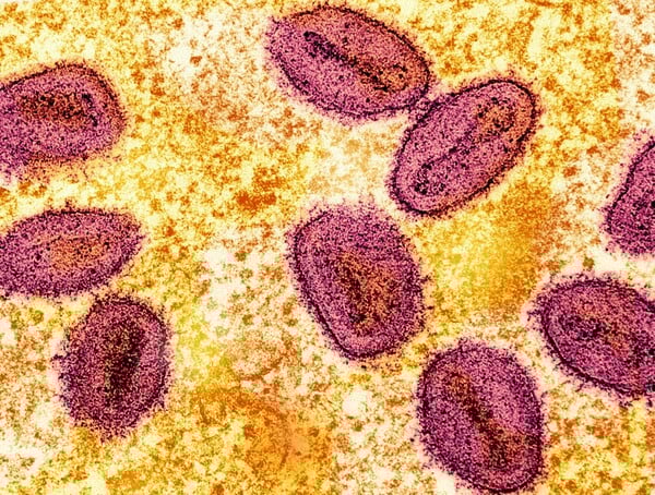 Το πιο επιθετικό στέλεχος της mpox εντοπίστηκε σε κάτοικο της Καλιφόρνια – Χωρίς επαφή με το εξωτερικό