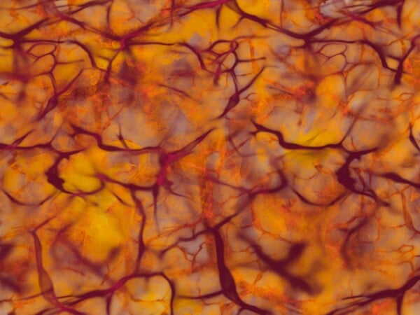 ΙΣΩΣ ΓΙΑ ΣΚ - Σκλήρυνση κατά πλάκας: Ανακαλύφθηκαν δύο υποτύποι με τη βοήθεια της τεχνητής νοημοσύνης 