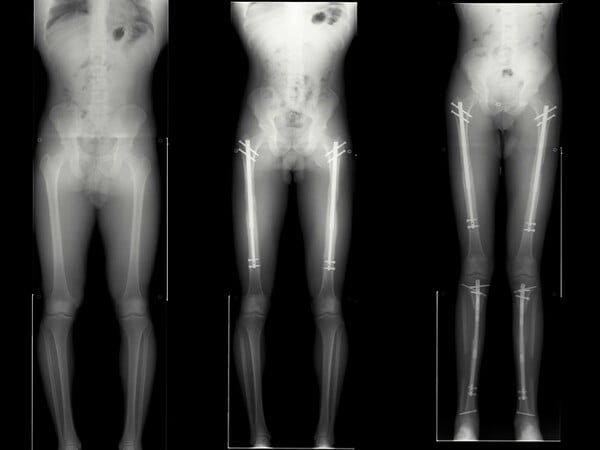 Κωνσταντινούπολη: Η μηχανή που σε κάνει να ψηλώνεις 