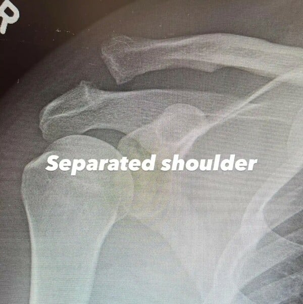 ΤΣΑΝΙΝΓΚ ΤΕΪΤΟΥΜ ΤΡΑΥΜΑΤΙΣΜΟΣ ΝΟΣΟΚΟΜΕΙΟ