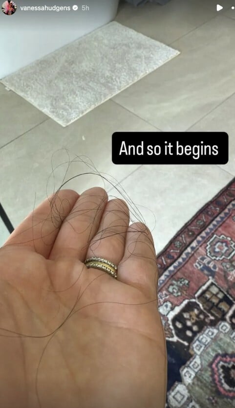 Βανέσα Χάτζενς: Οι φωτογραφίες με την απώλεια μαλλιών και τη ζωή μετά τον τοκετό