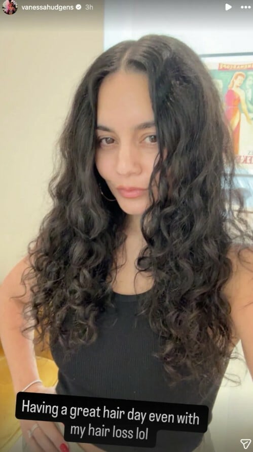 Βανέσα Χάτζενς: Οι φωτογραφίες με την απώλεια μαλλιών και τη ζωή μετά τον τοκετό