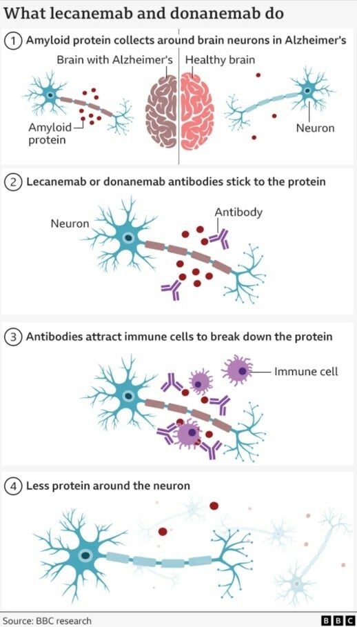 ΑΛΤΣΧΑΙΜΕΡ ΝΕΑ ΦΑΡΜΑΚΑ ΟΧΙ ΕΠΙΔΡΑΣΗ ΕΡΕΥΝΑ