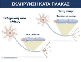 Σκλήρυνση Κατά Πλάκας Συμπτώματα - Παράγοντες Κινδύνου - Αντιμετώπιση 