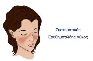 Συστηματικός Ερυθηματώδης Λύκος (ΣΕΛ) Συμπτώματα – Αίτια